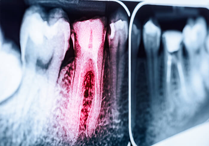 X-ray of infected root canal