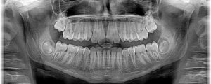 safe dental X-ray showing top and bottom adult teeth and jawbone